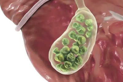 得了膽結石不能吃什么食物 膽結石飲食需要注意什